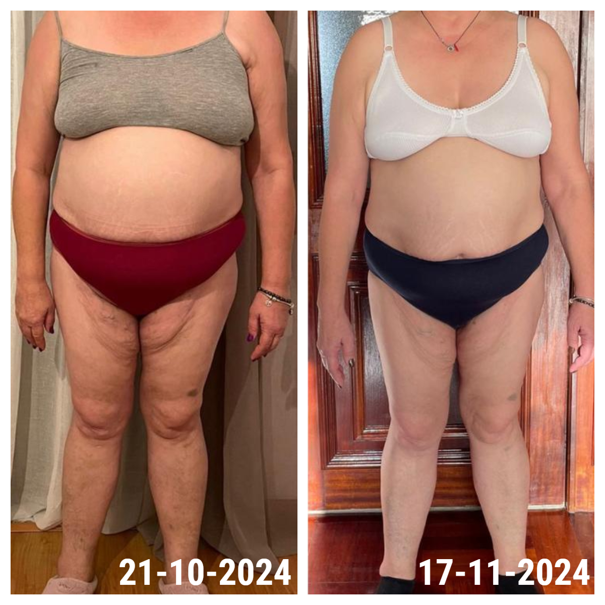 Resultado antes e depois de uma aluna INSHAPE